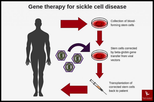 Gene Therapy