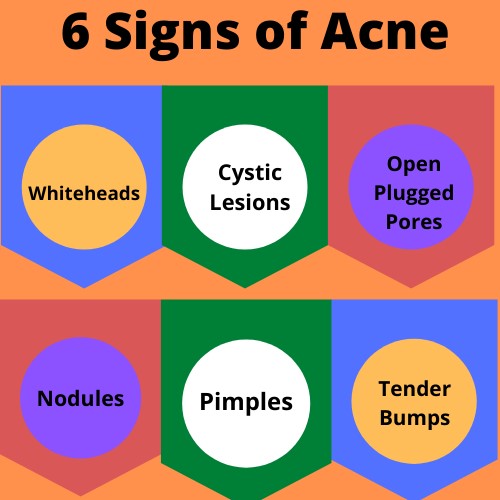 acne assignment help