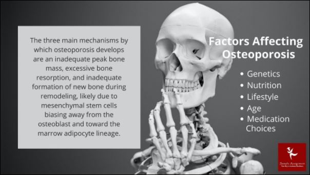 osteoporosis nursing homework Canada